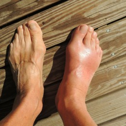6 Tips To Protect The Health Of Your Feet With Diabetes