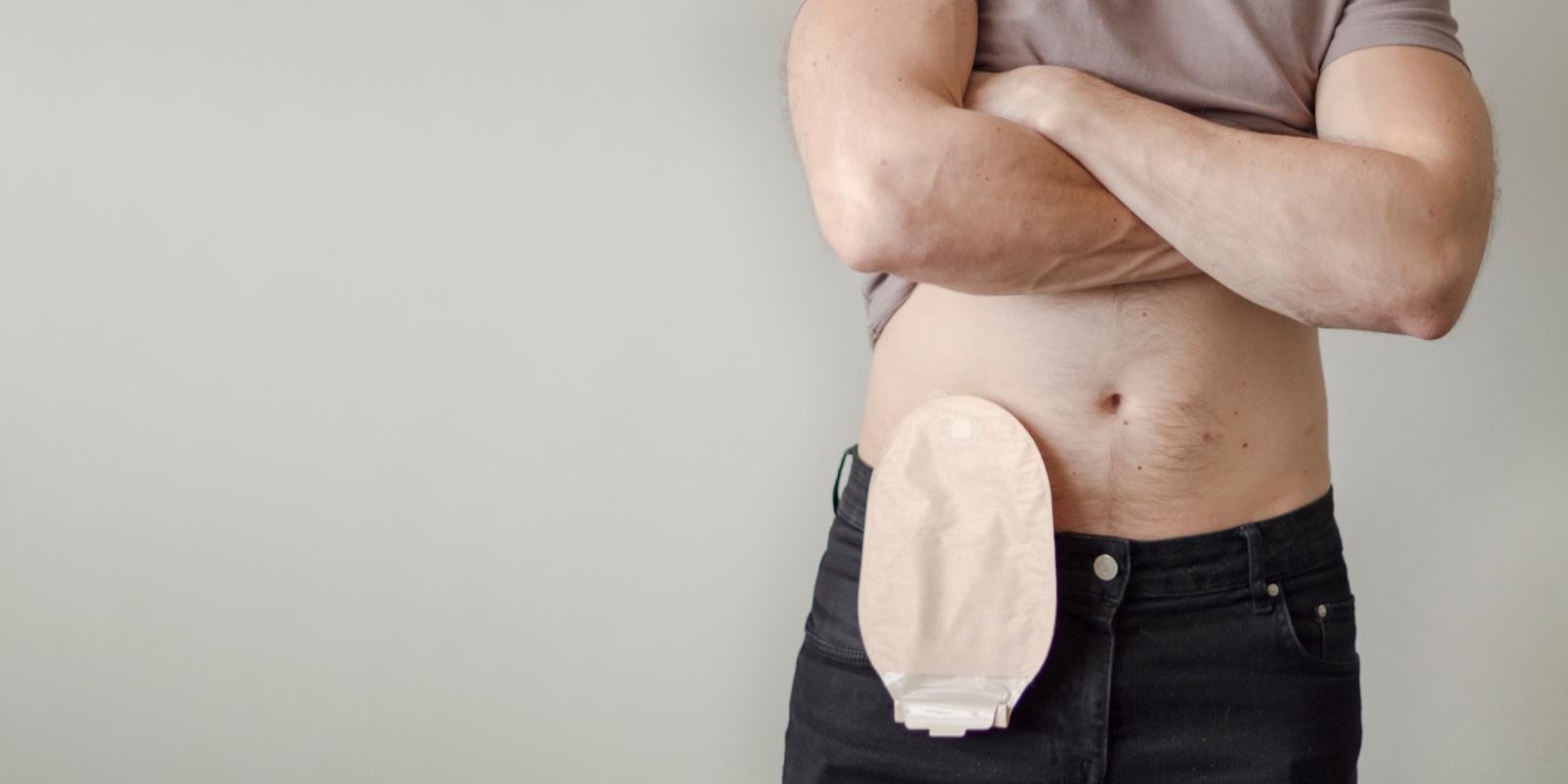Person wearing ostomy bag