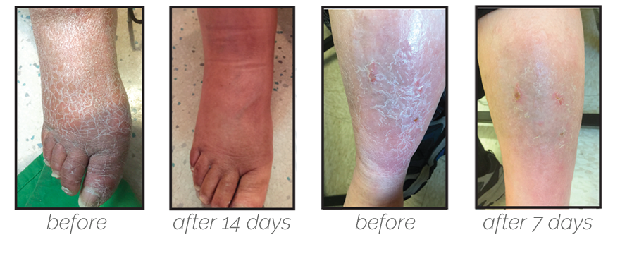 K5 diabetic foot cream progress pictures